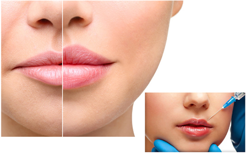 SAU LÀM ĐẸP VÙNG MÔI