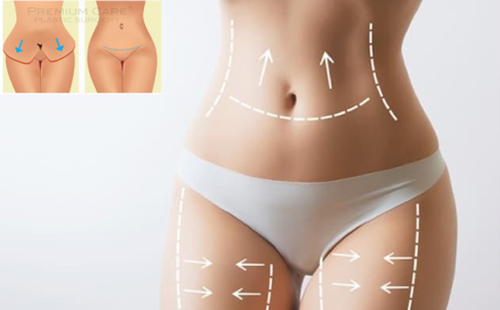 SAU TẠO HÌNH VÙNG BỤNG - ĐÙI